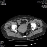 Комп'ютерна томографія (КТ) органів малого тазу (з внутрішньовенним контрастом)