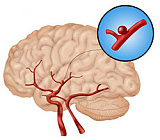 Кліпіювання мішотчатої аневризми судин головного мозку