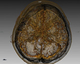 Комп'ютерна томографія (КТ) головного мозку (з внутрішньовенним контрастом)