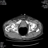 Комп'ютерна томографія (КТ) кістково-суглобової системи (з внутрішньовенним контрастом)