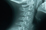 Рентгенографія функціональна шийного відділу хребта