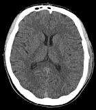 Комп'ютерна томографія (КТ) головного мозку