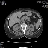 Комп'ютерна томографія (КТ) органів черевної порожнини, малого тазу з пероральним прийомом урографіну