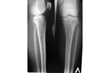 Рентгенографія колінного суглобу